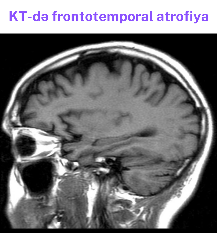 alzheimer-1.png