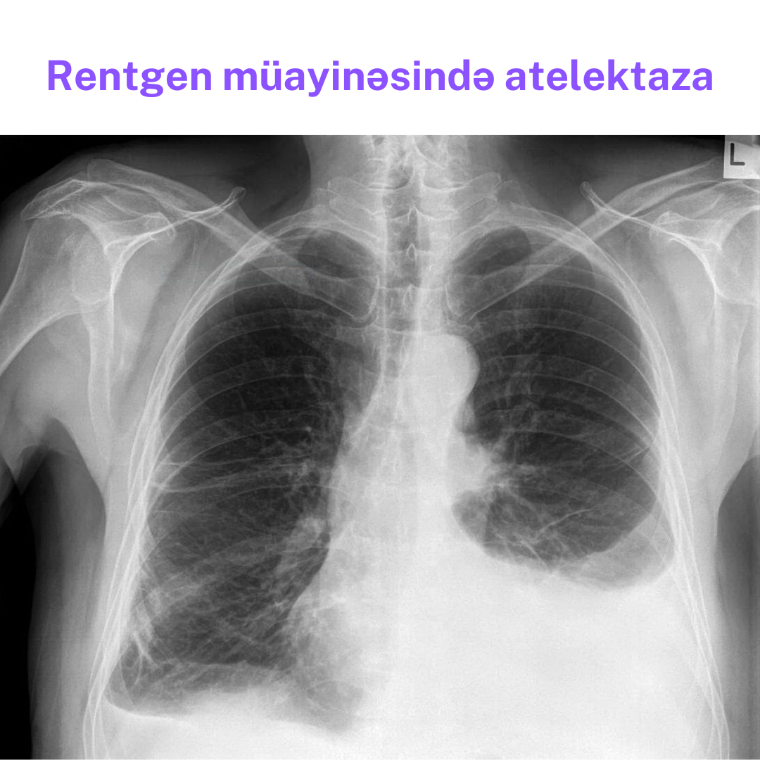 atelektaza.png