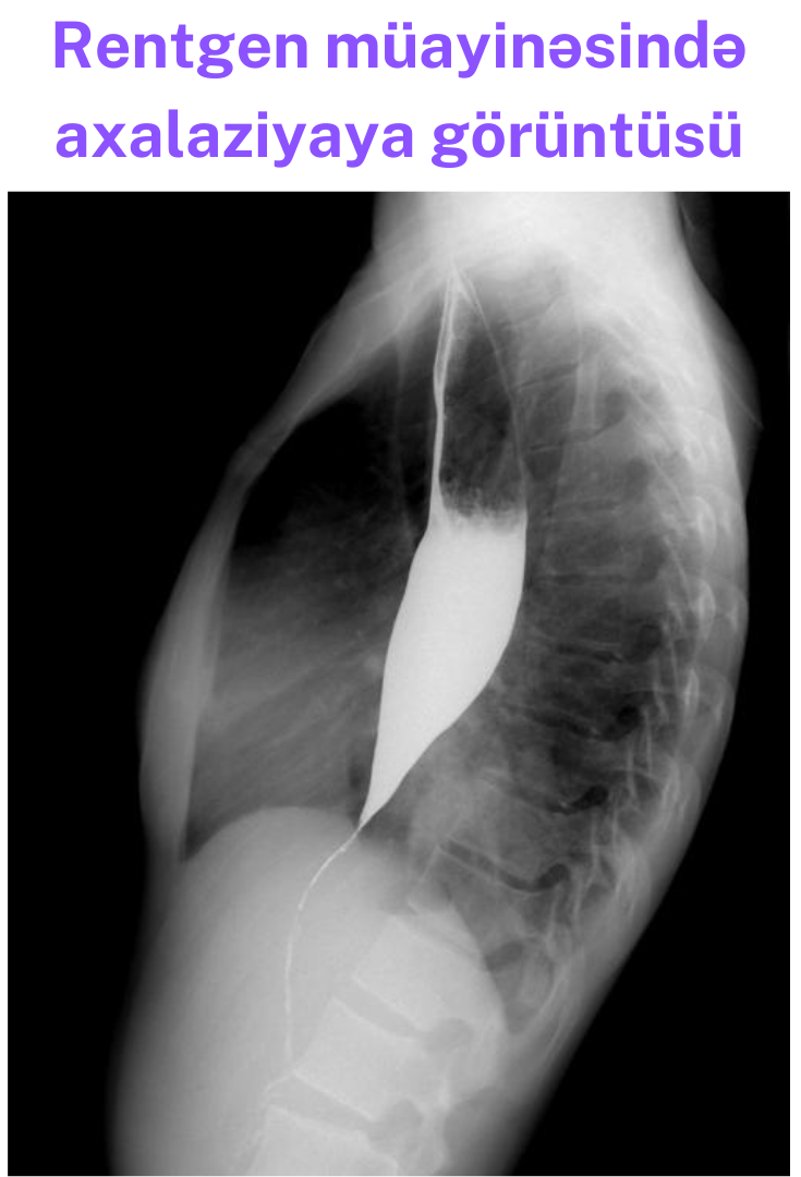 axalaziya-rentgende.png