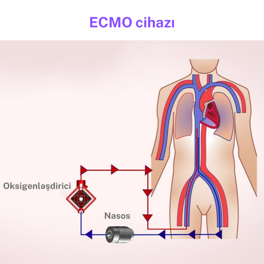 ecmo.png