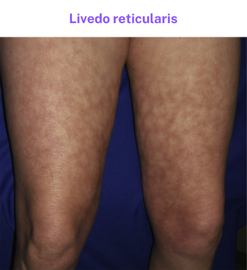 livedo-reticularis.png
