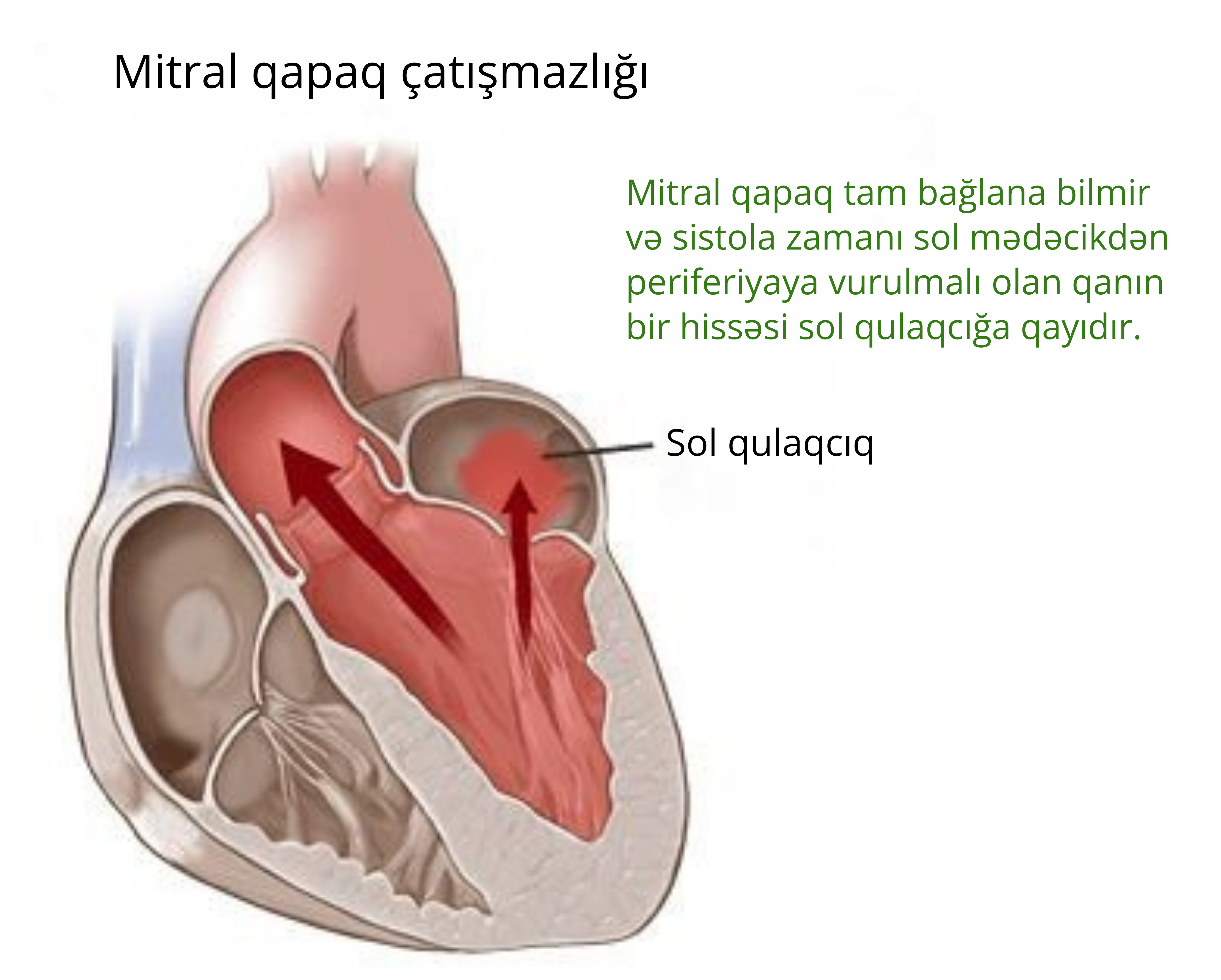 mitral-catismazliq.png