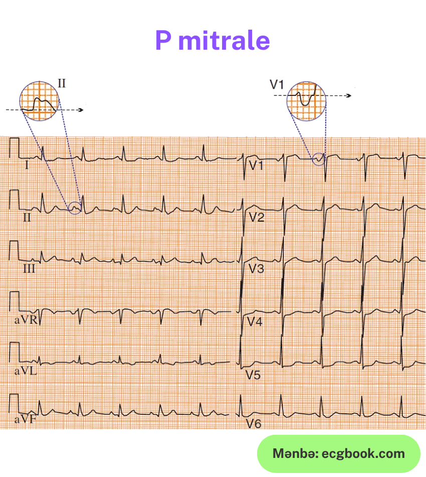p-mitrale.png