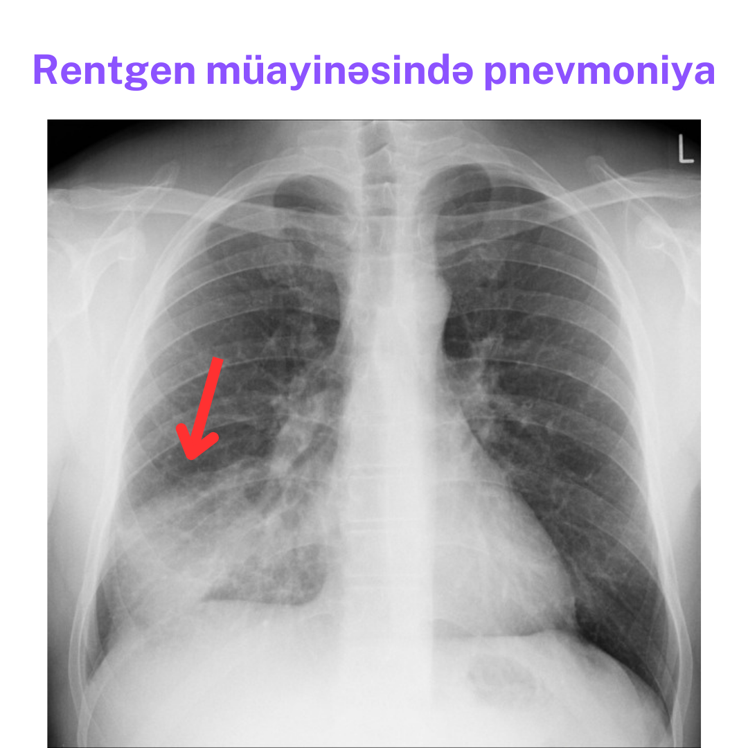 pnevmoniya.png